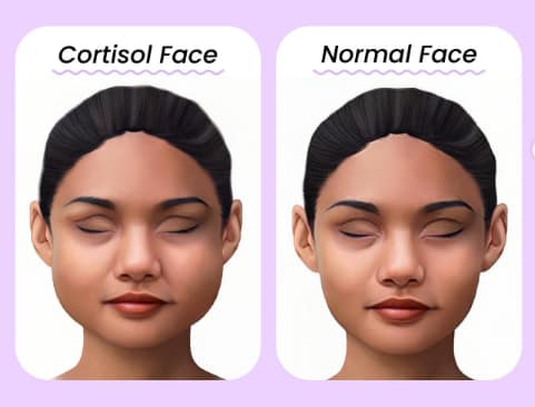 Cortisol face: Kako prepoznaš stresno zabuhlost in jo odpraviš?