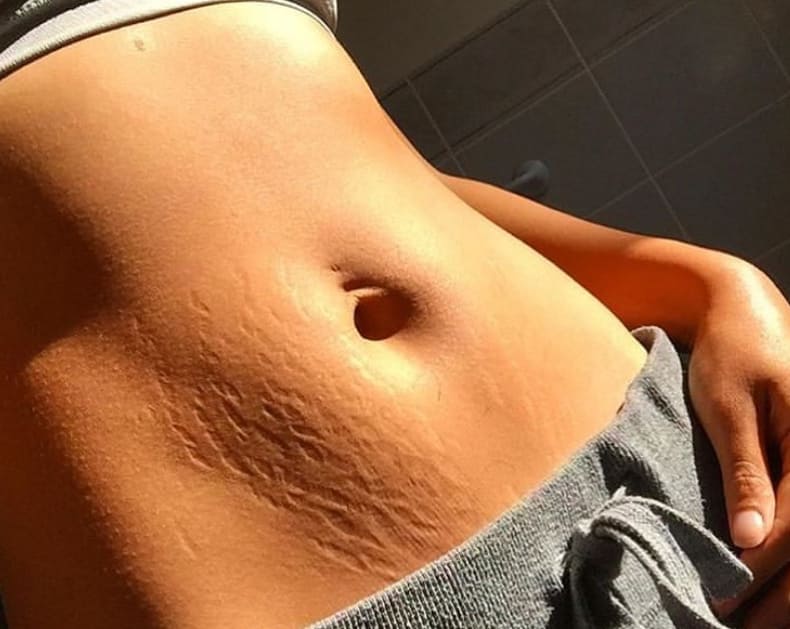 Strije so naraven pojav, ki prizadene skoraj vsako telo. Odkrijte resnico o tem, zakaj koža "poka", kako s pravilno nego izboljšati njeno elastičnost in ali kreme zares delujejo. Preberite vse o preprečevanju in sprejemanju svojih unikatnih tigrovih črt