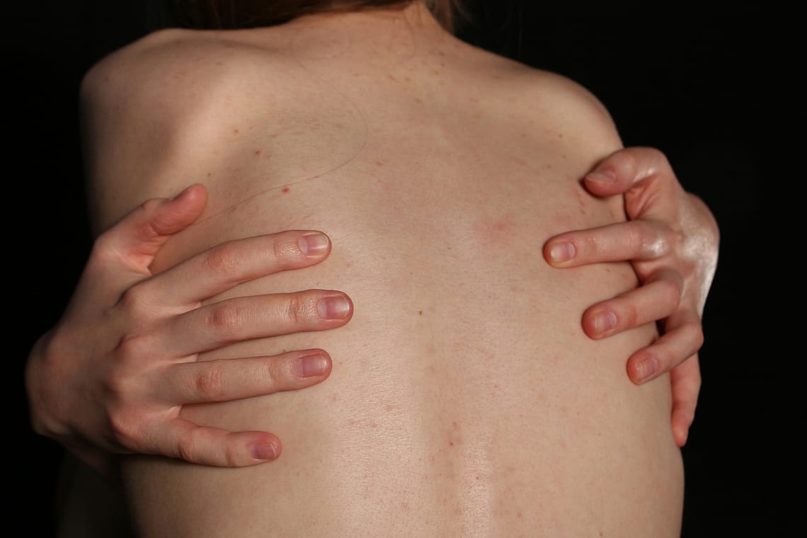 Akne na hrbtu so trdovratna težava, pri kateri običajna mila pogosto odpovejo. Odkrijte strokovne nasvete dermatologov o najboljših tretmajih in navadah za gladko kožo.