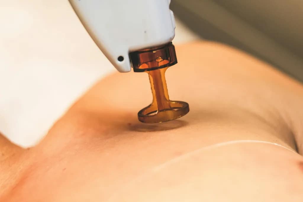 Lasersko odstranjevanje dlak morda ni 100-odstotno trajno za vsakogar v vseh okoliščinah, je pa najbližje temu idealu, kar nam moderna medicina omogoča. Večina uporabnikov uživa v gladki koži dolga leta, preden potrebujejo kratek "osvežitveni" tretma.