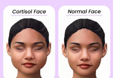Cortisol face: Kako prepoznaš stresno zabuhlost in jo odpraviš?