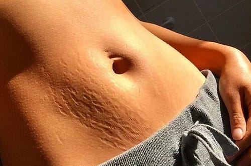 Strije so naraven pojav, ki prizadene skoraj vsako telo. Odkrijte resnico o tem, zakaj koža "poka", kako s pravilno nego izboljšati njeno elastičnost in ali kreme zares delujejo. Preberite vse o preprečevanju in sprejemanju svojih unikatnih tigrovih črt
