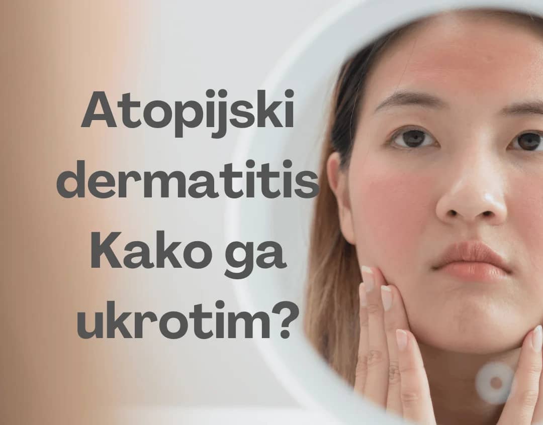 Atopijski dermatitis Kako ga ukrotim 1 e1739121574672
